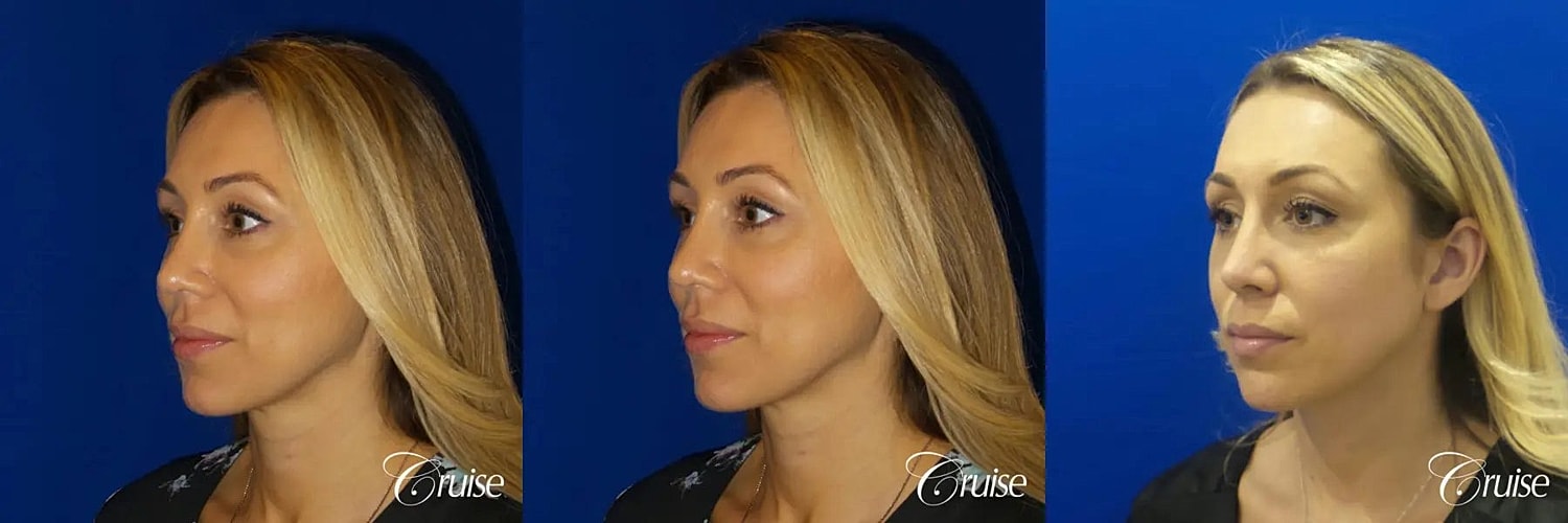 Rhinoplasty Before & After