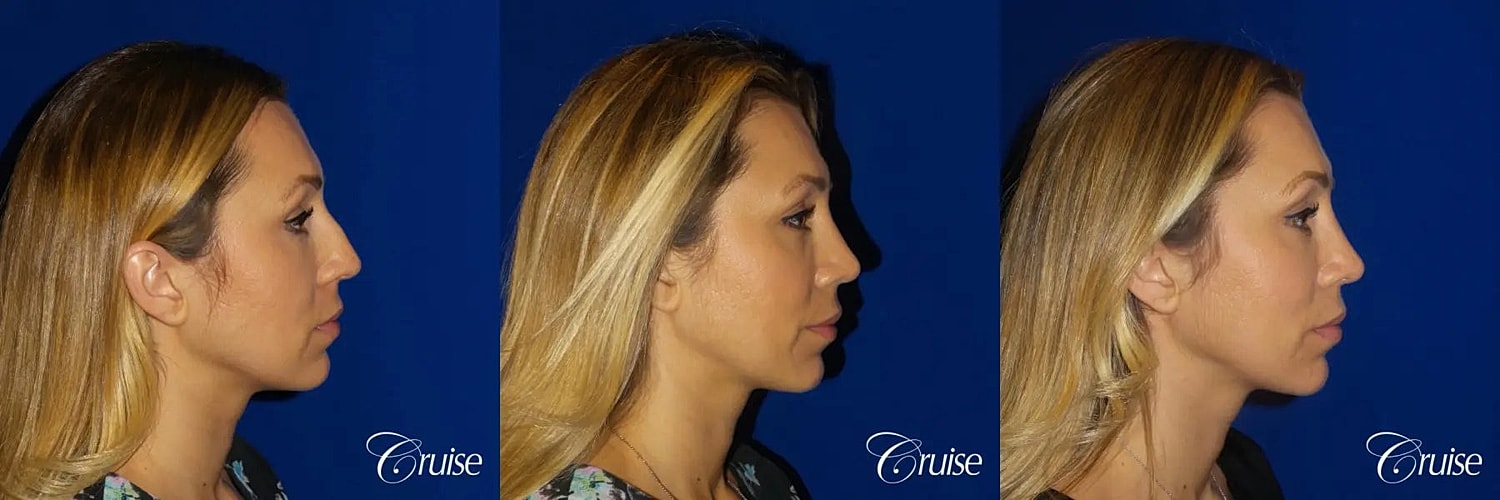Rhinoplasty Before & After