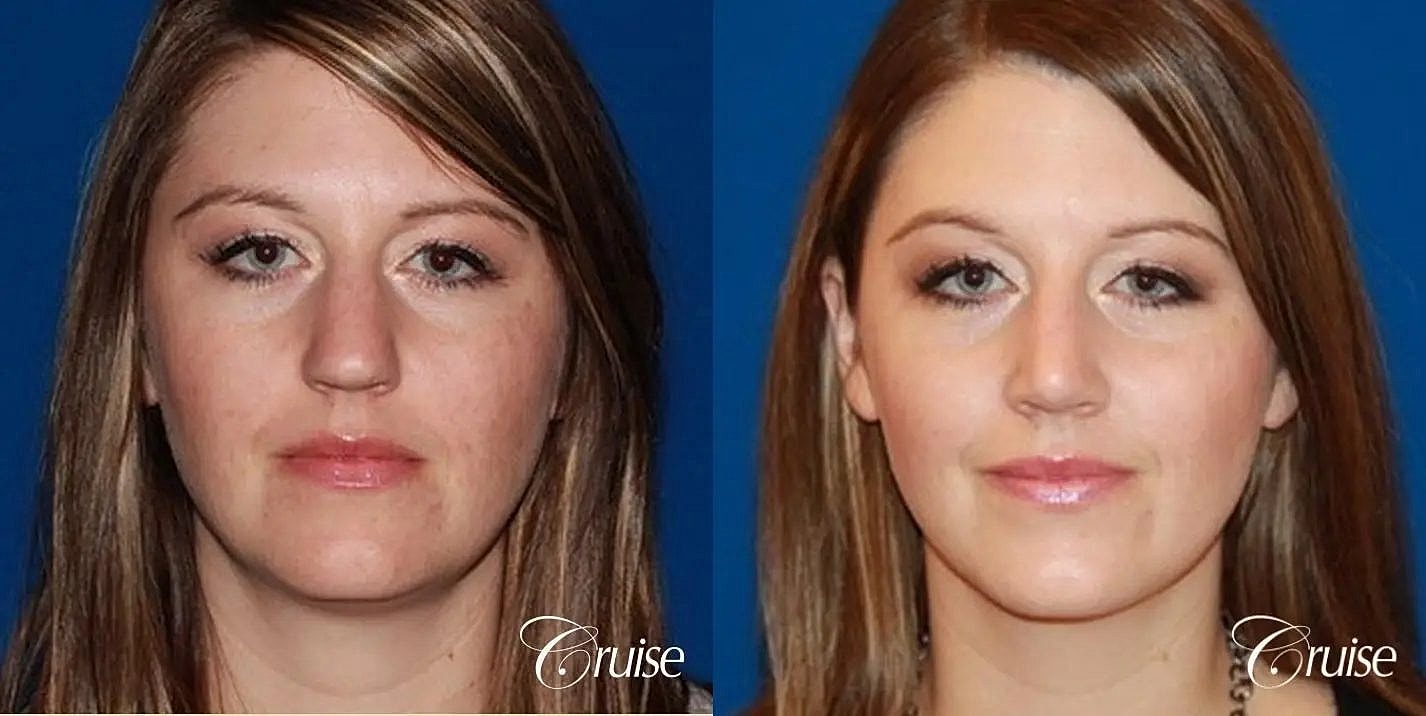 Rhinoplasty Before & After