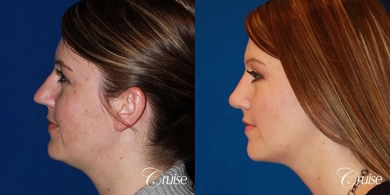 Rhinoplasty Before & After