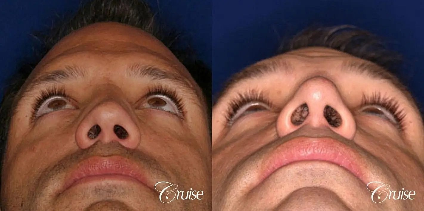 Rhinoplasty Before & After