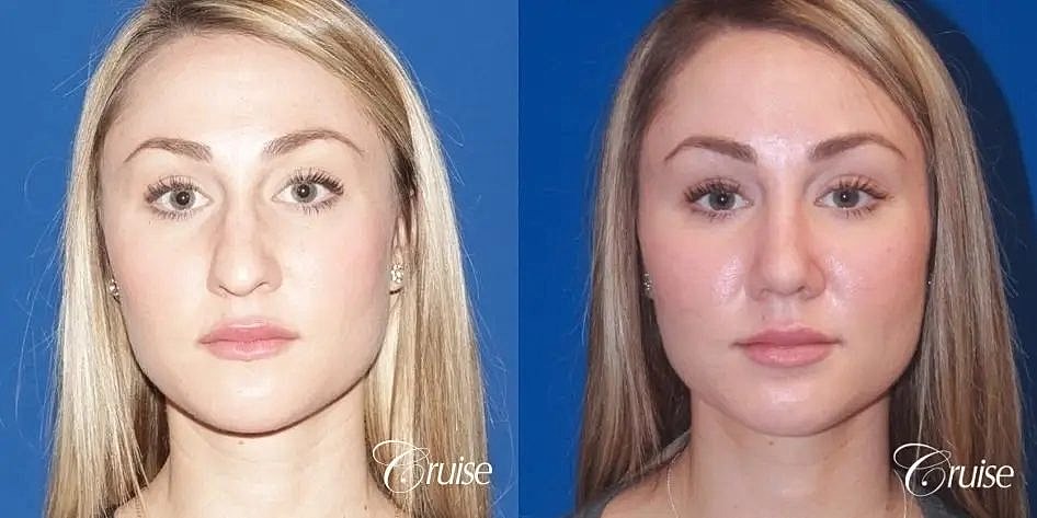 Rhinoplasty Before & After