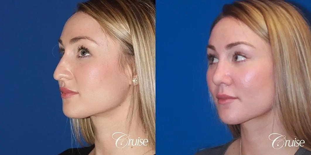 Rhinoplasty Before & After