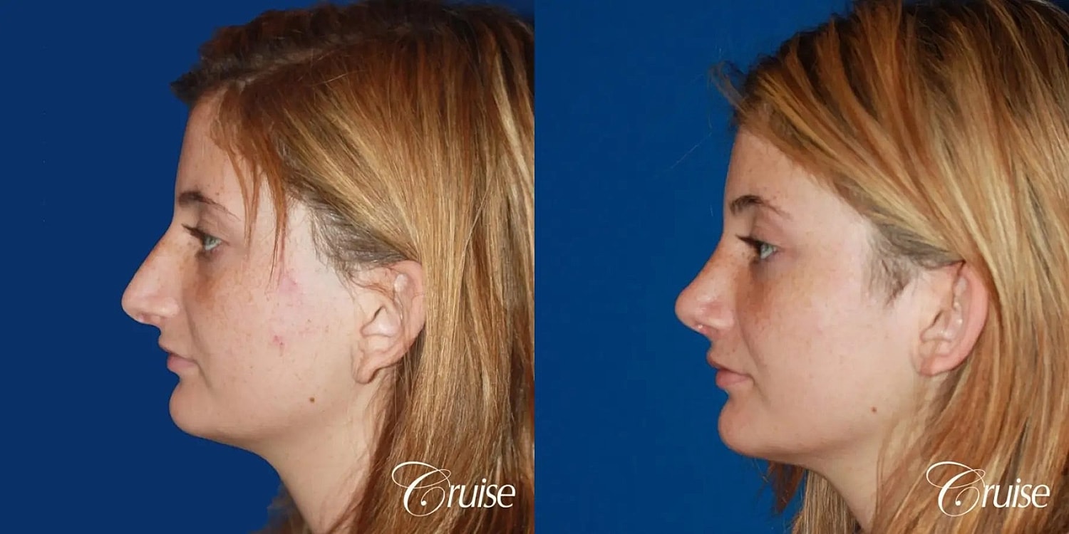 Rhinoplasty Before & After