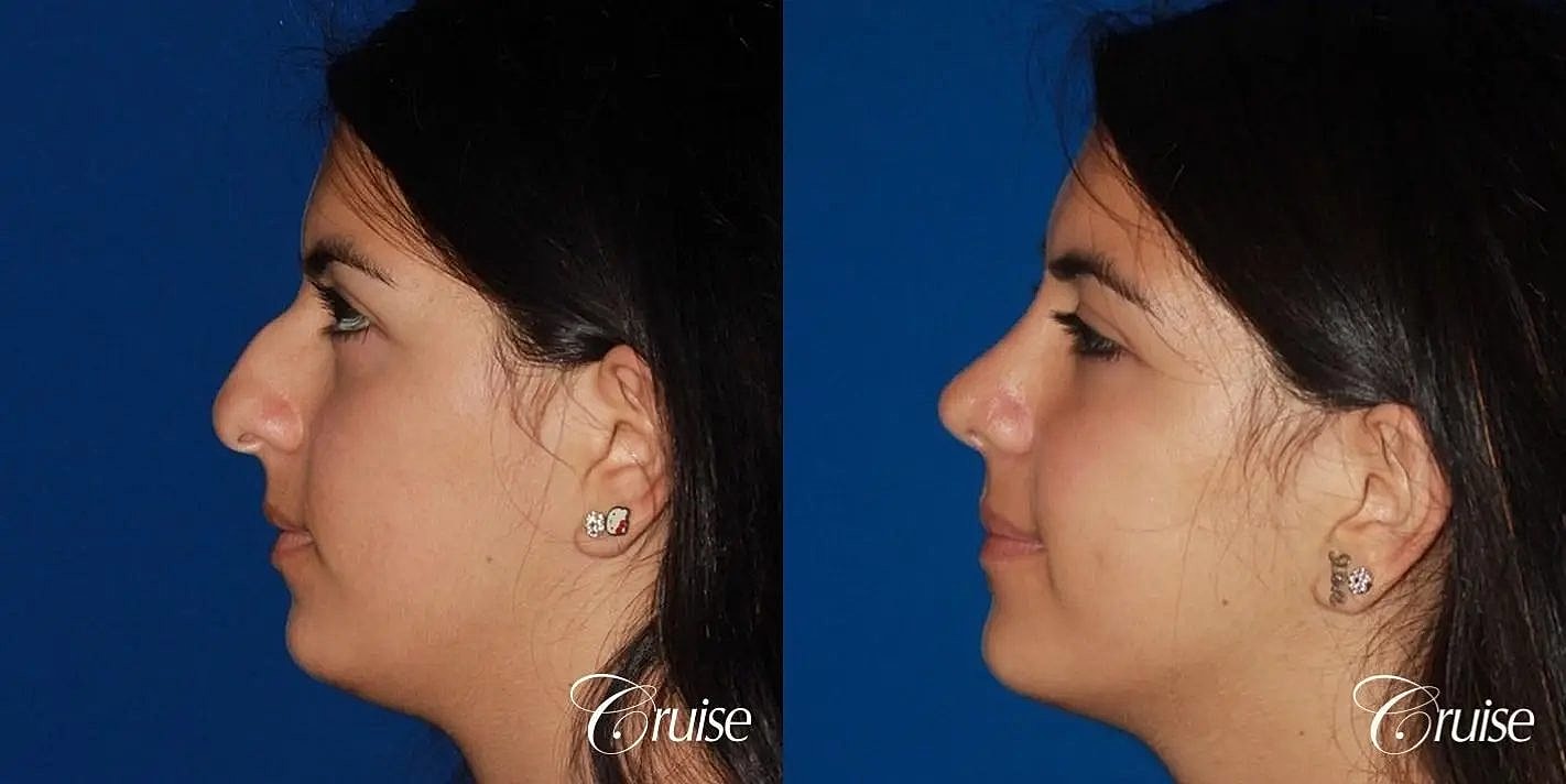 Rhinoplasty Before & After