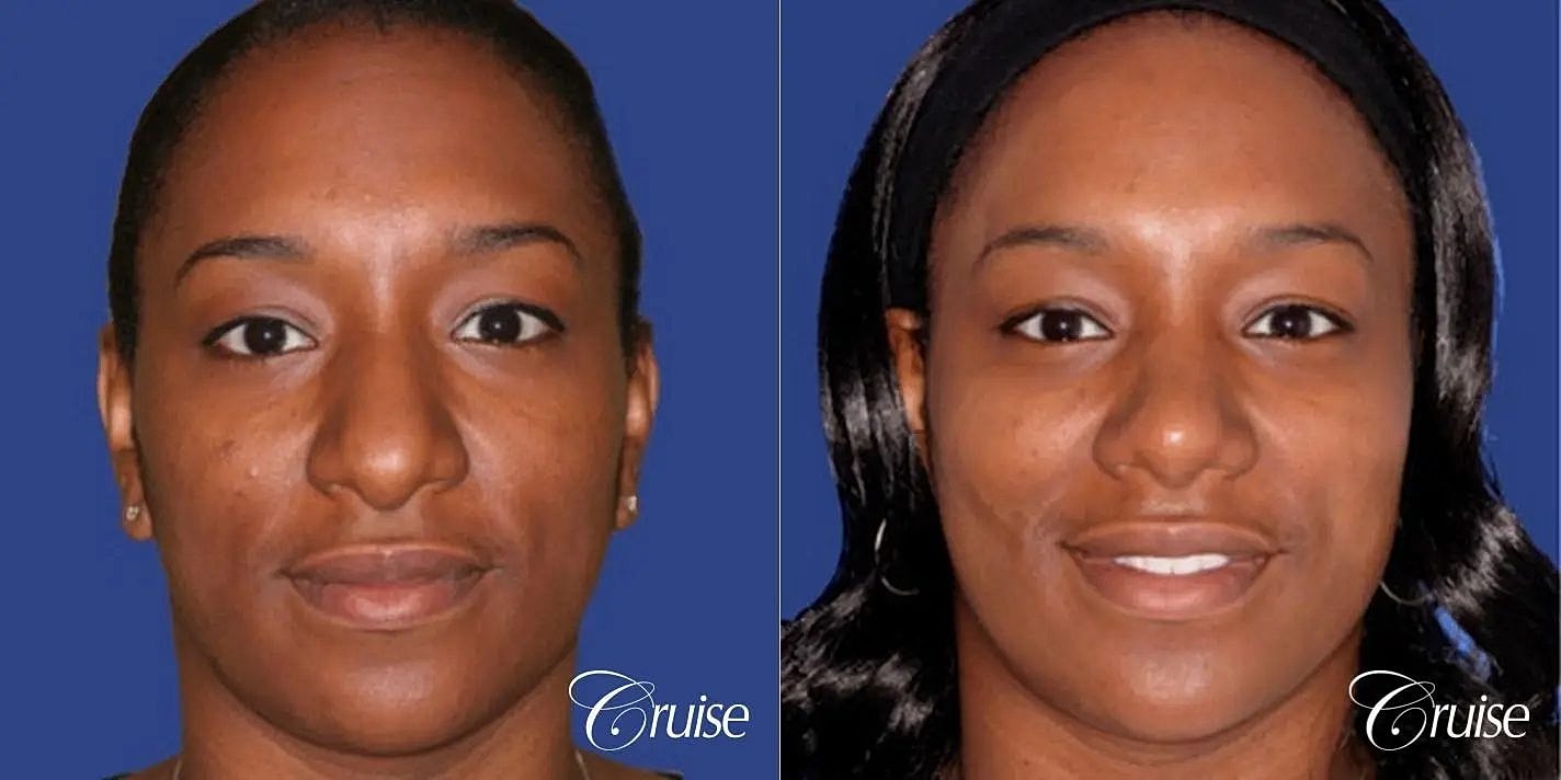Rhinoplasty Before & After