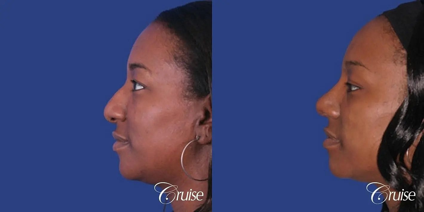 Rhinoplasty Before & After