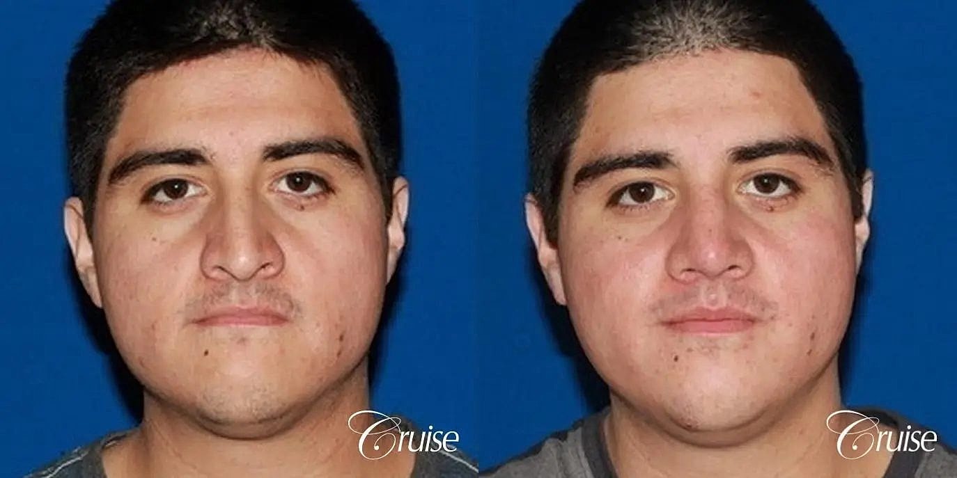 Rhinoplasty Before & After