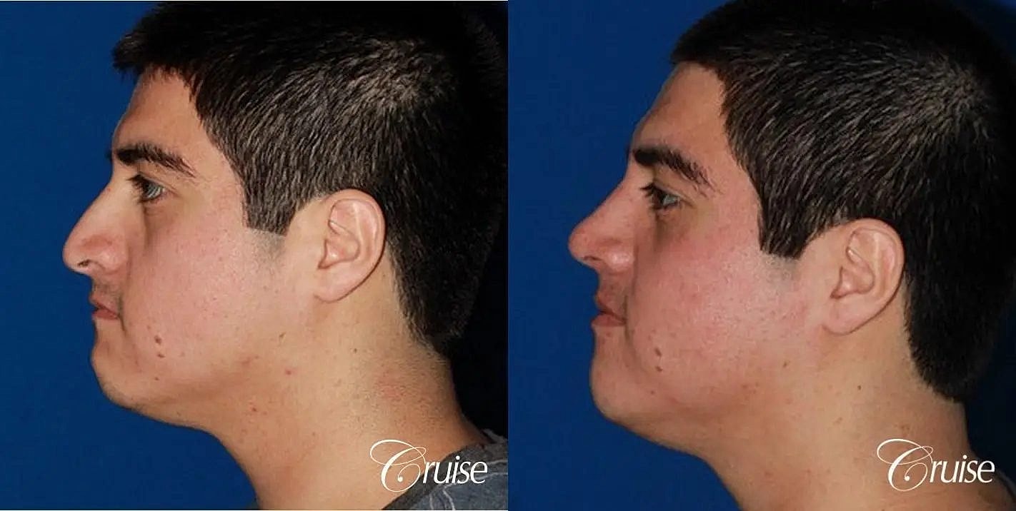 Rhinoplasty Before & After