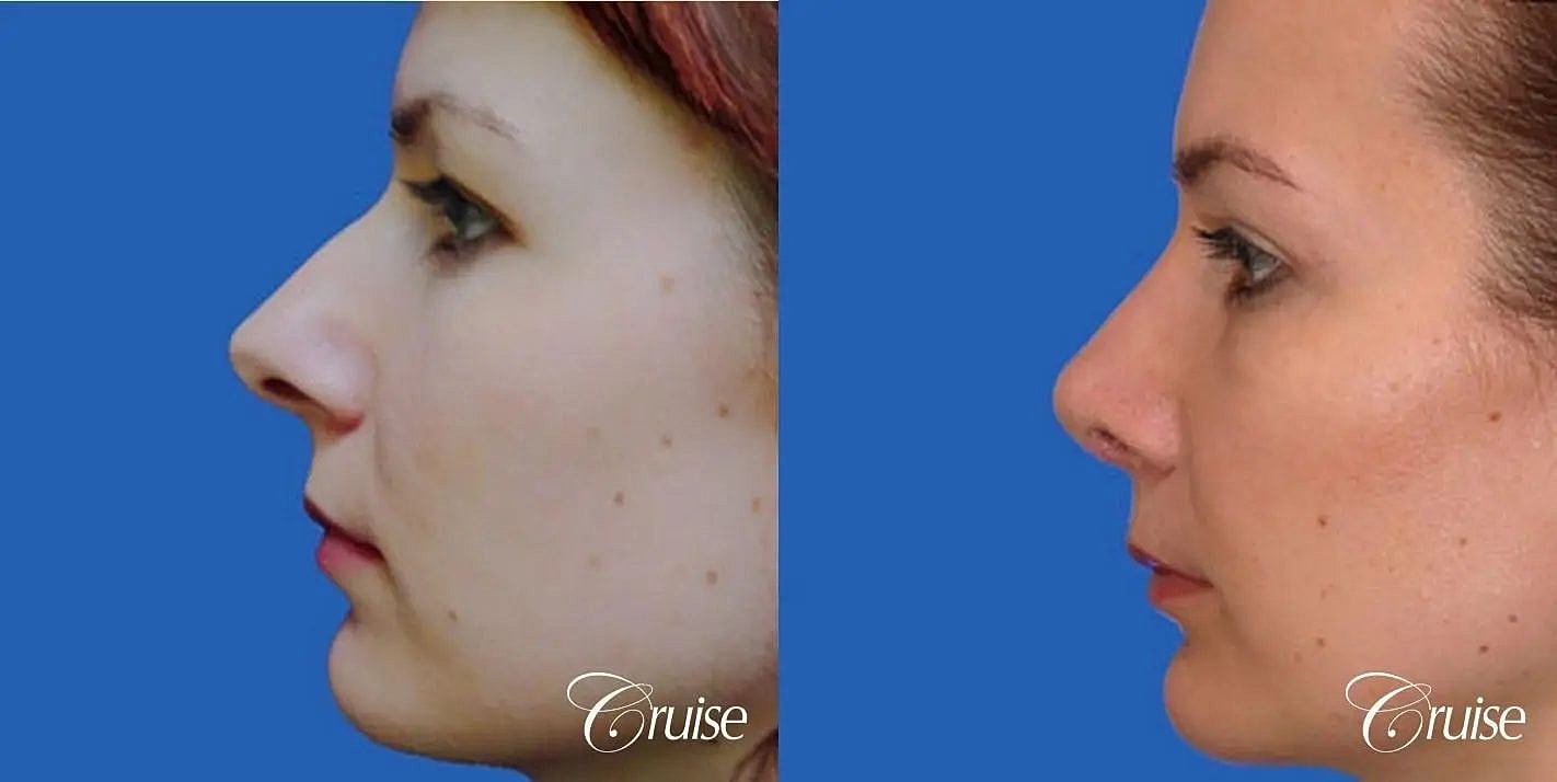 Rhinoplasty Before & After