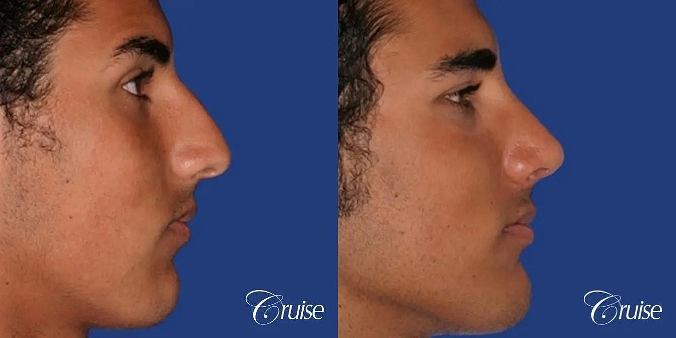 Rhinoplasty Before & After