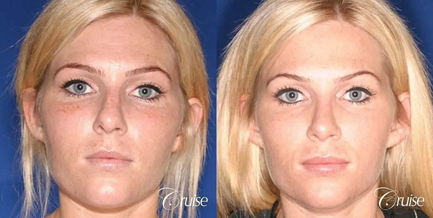 Rhinoplasty Before & After