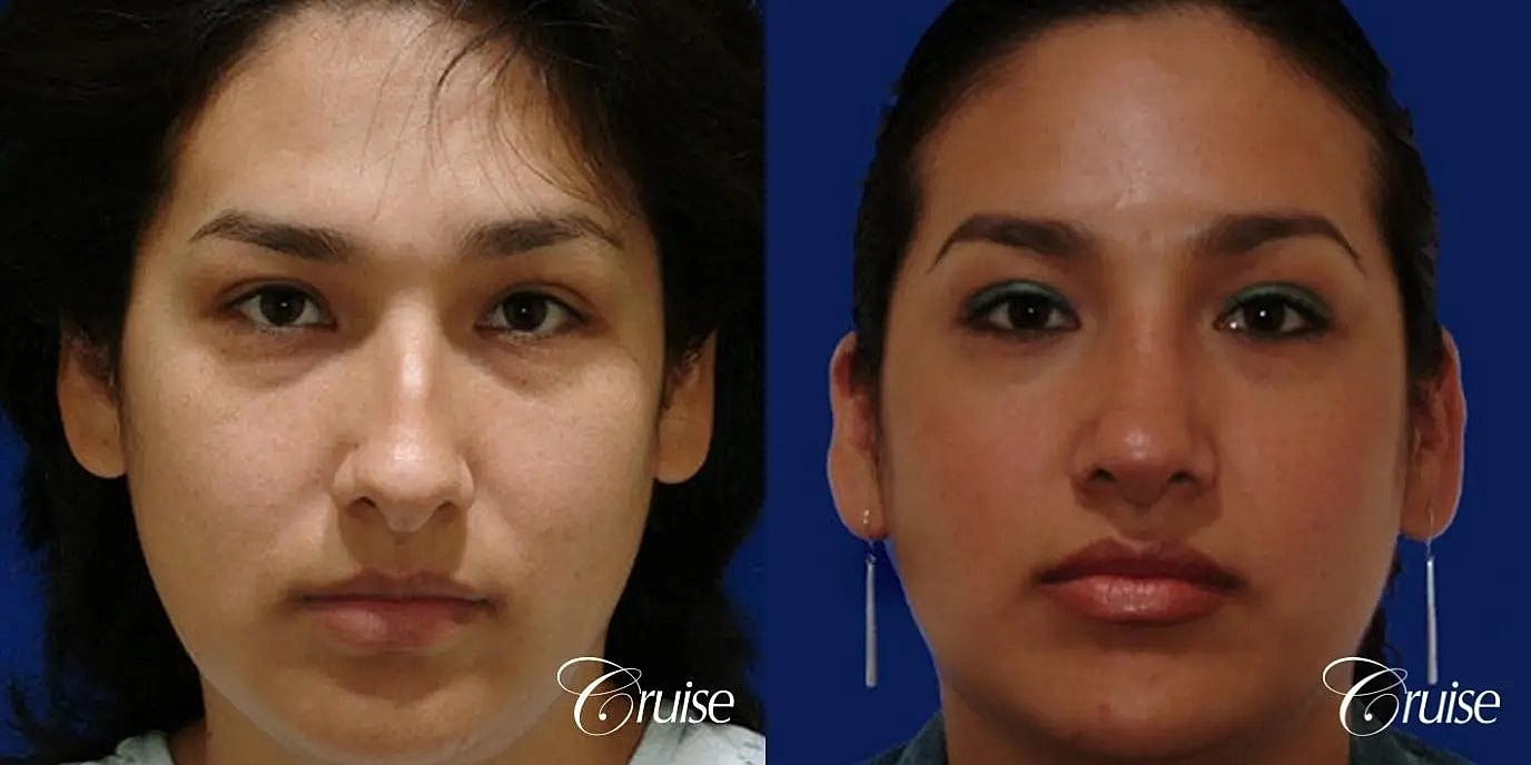 Rhinoplasty Before & After