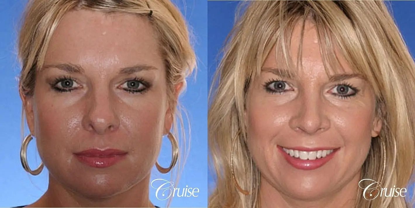 Rhinoplasty Before & After