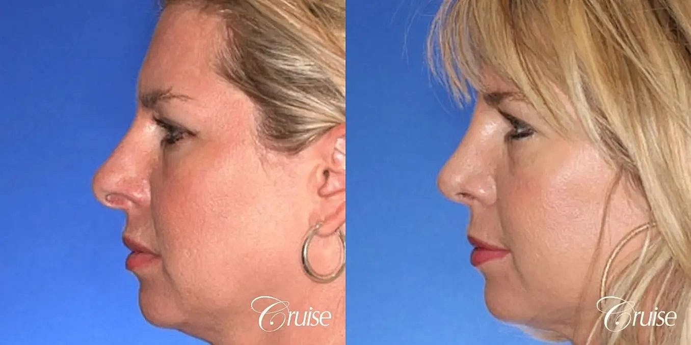 Rhinoplasty Before & After