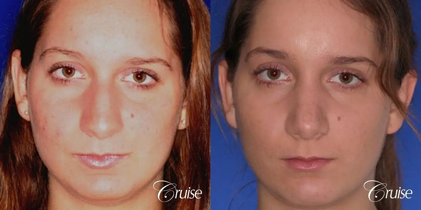 Rhinoplasty Before & After