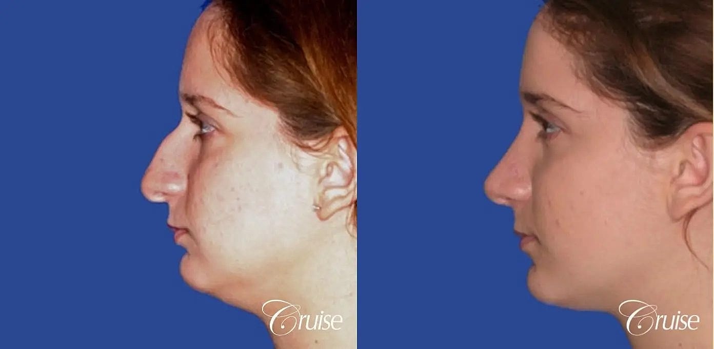 Rhinoplasty Before & After