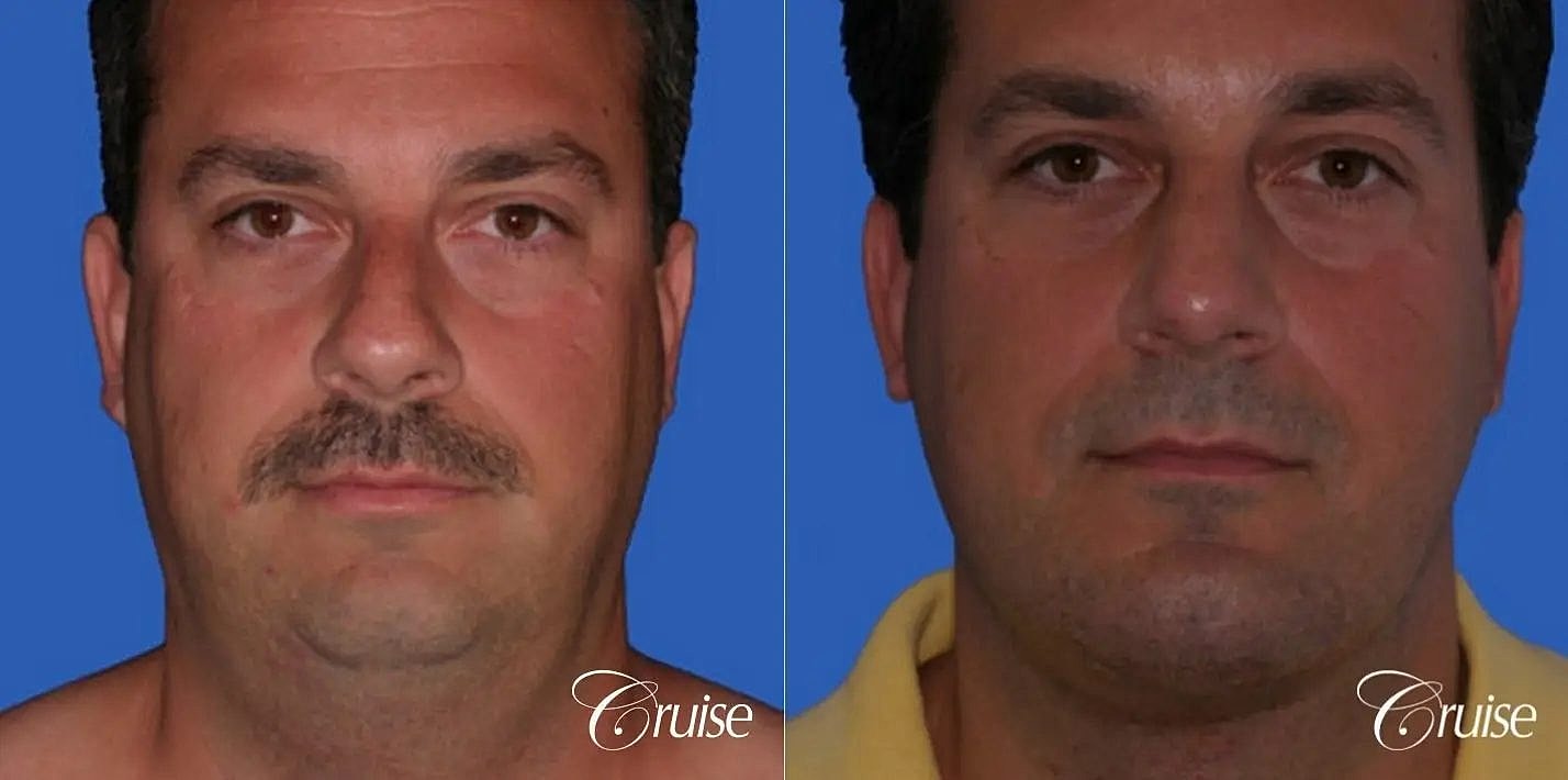 Rhinoplasty Before & After
