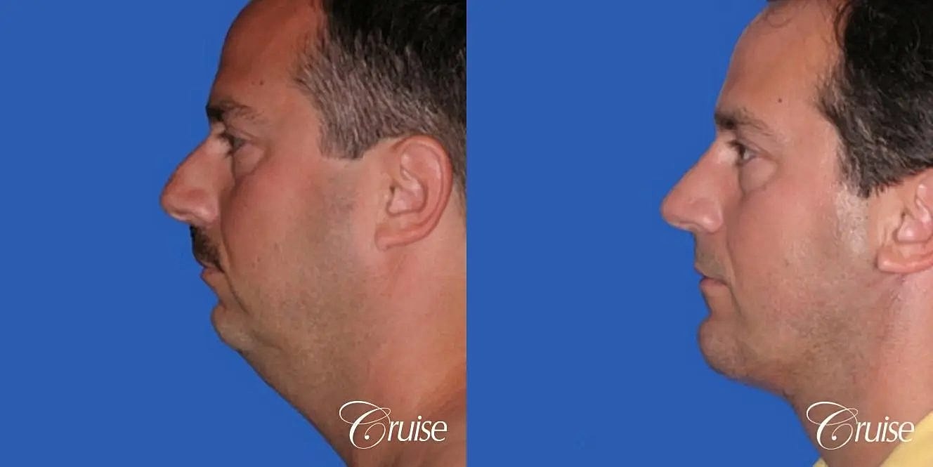 Rhinoplasty Before & After