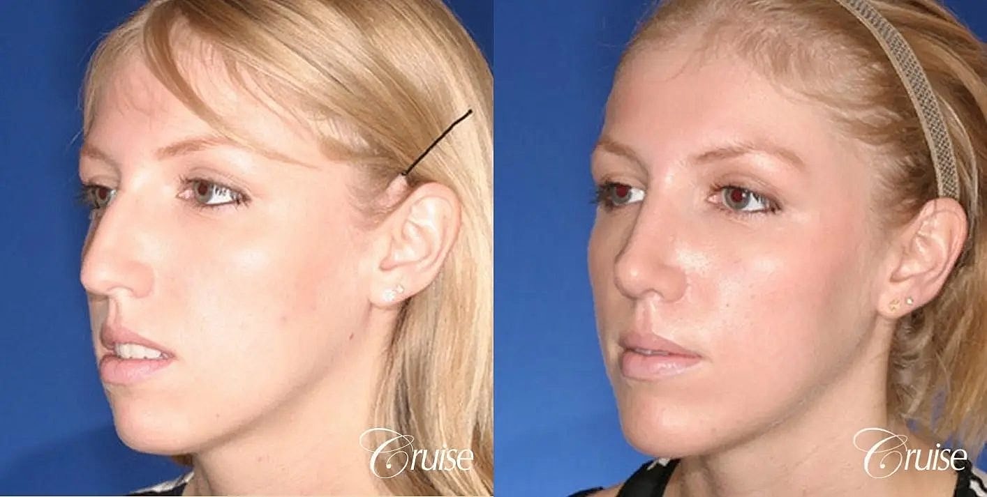 Rhinoplasty Before & After