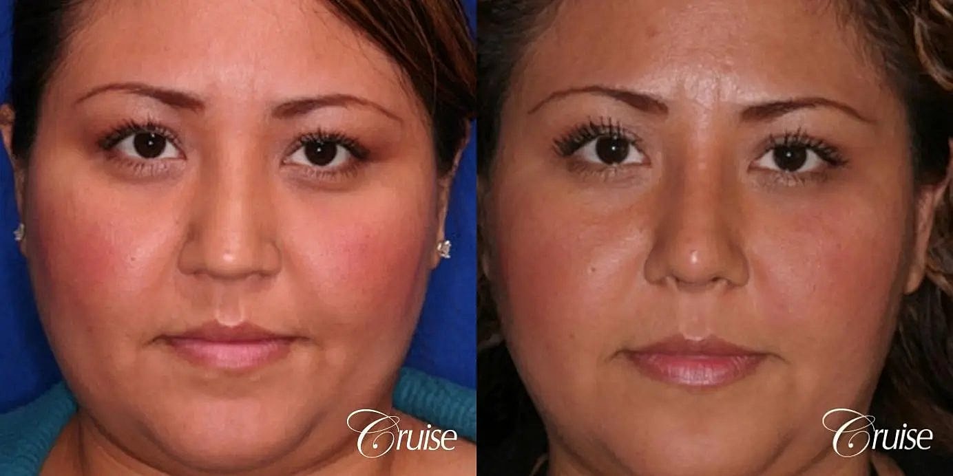 Rhinoplasty Before & After