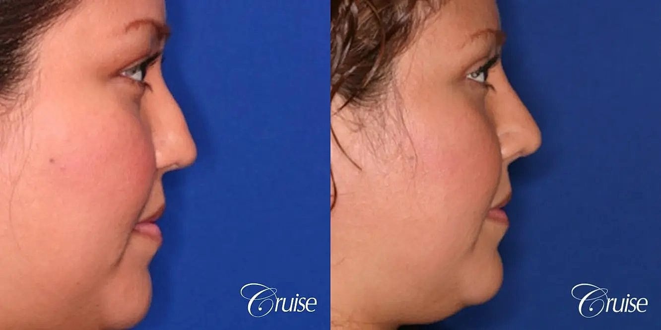 Rhinoplasty Before & After