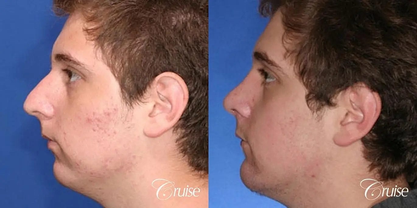 Rhinoplasty Before & After