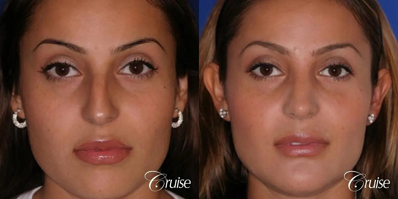 Rhinoplasty Before & After