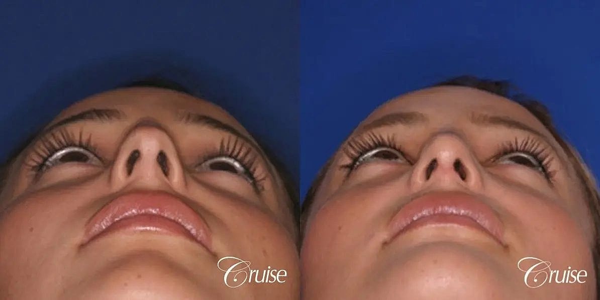 Rhinoplasty Before & After
