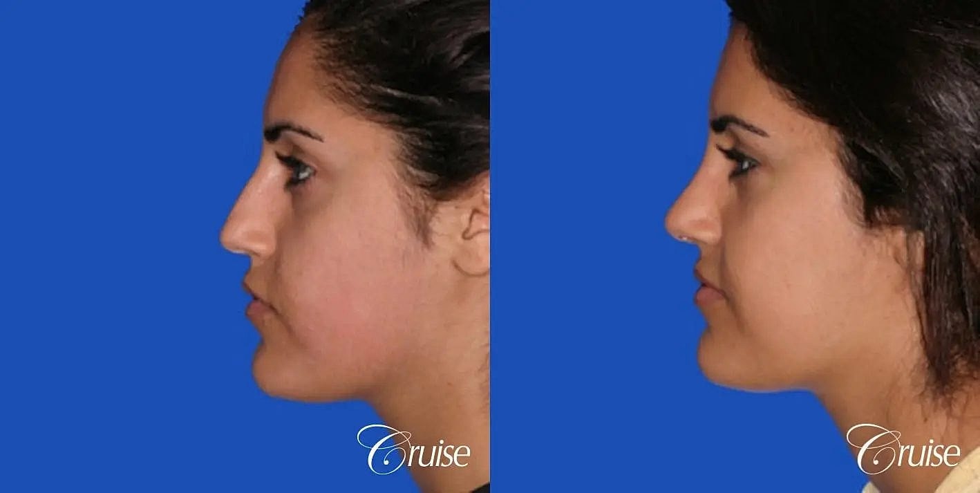 Rhinoplasty Before & After
