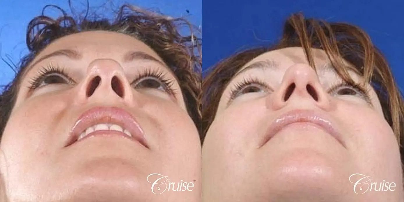 Rhinoplasty Before & After