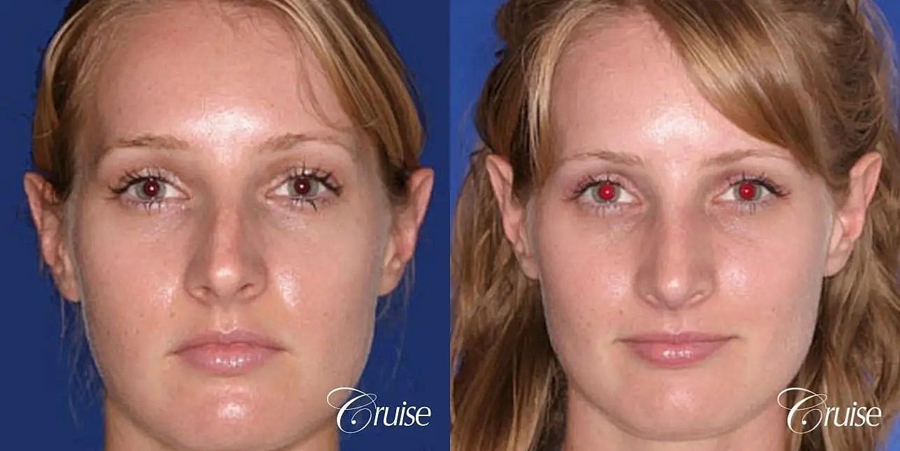 Rhinoplasty Before & After