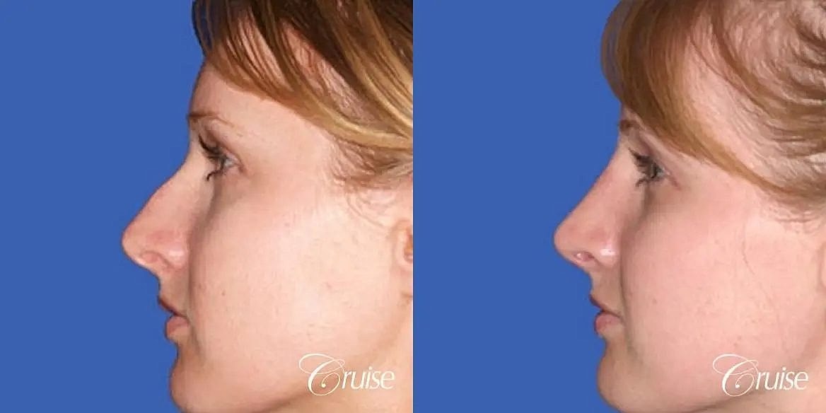 Rhinoplasty Before & After