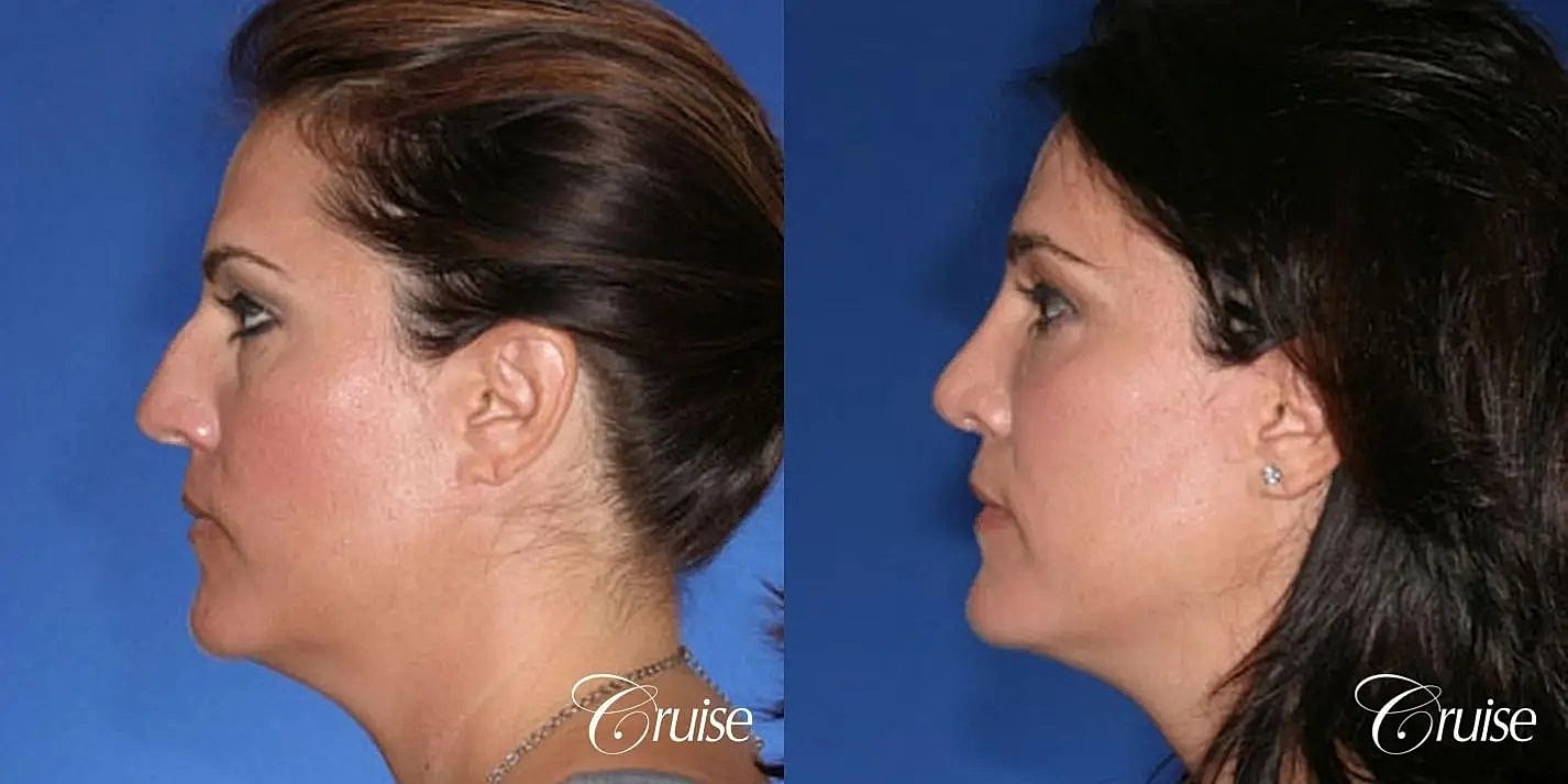 Rhinoplasty Before & After