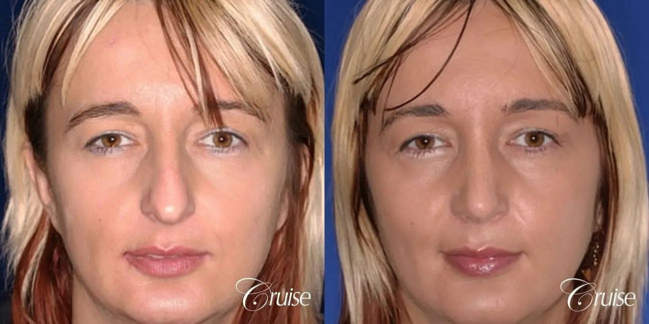 Rhinoplasty Before & After