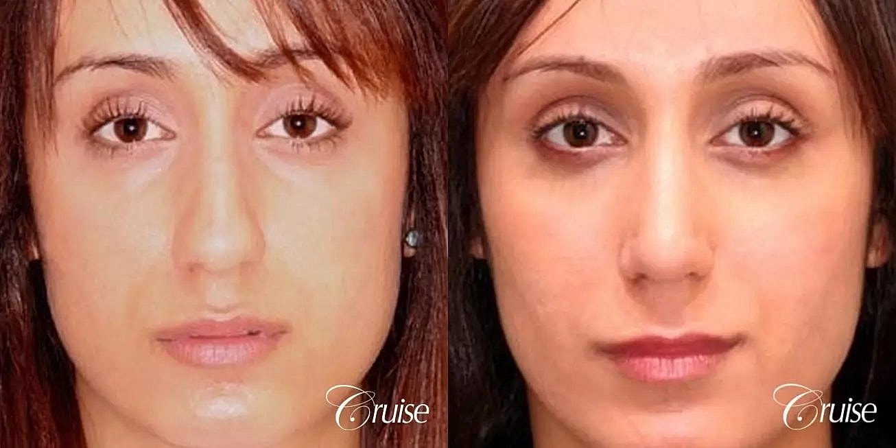 Rhinoplasty Before & After