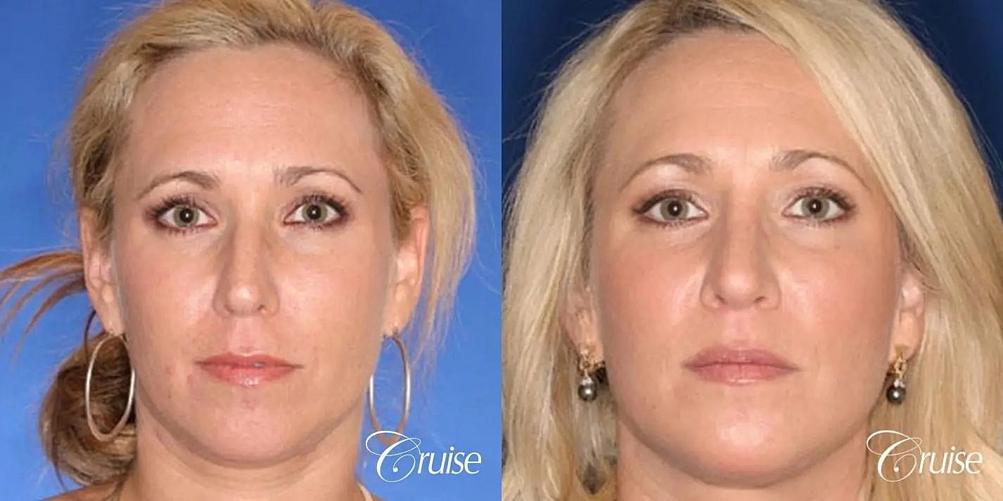 Rhinoplasty Before & After