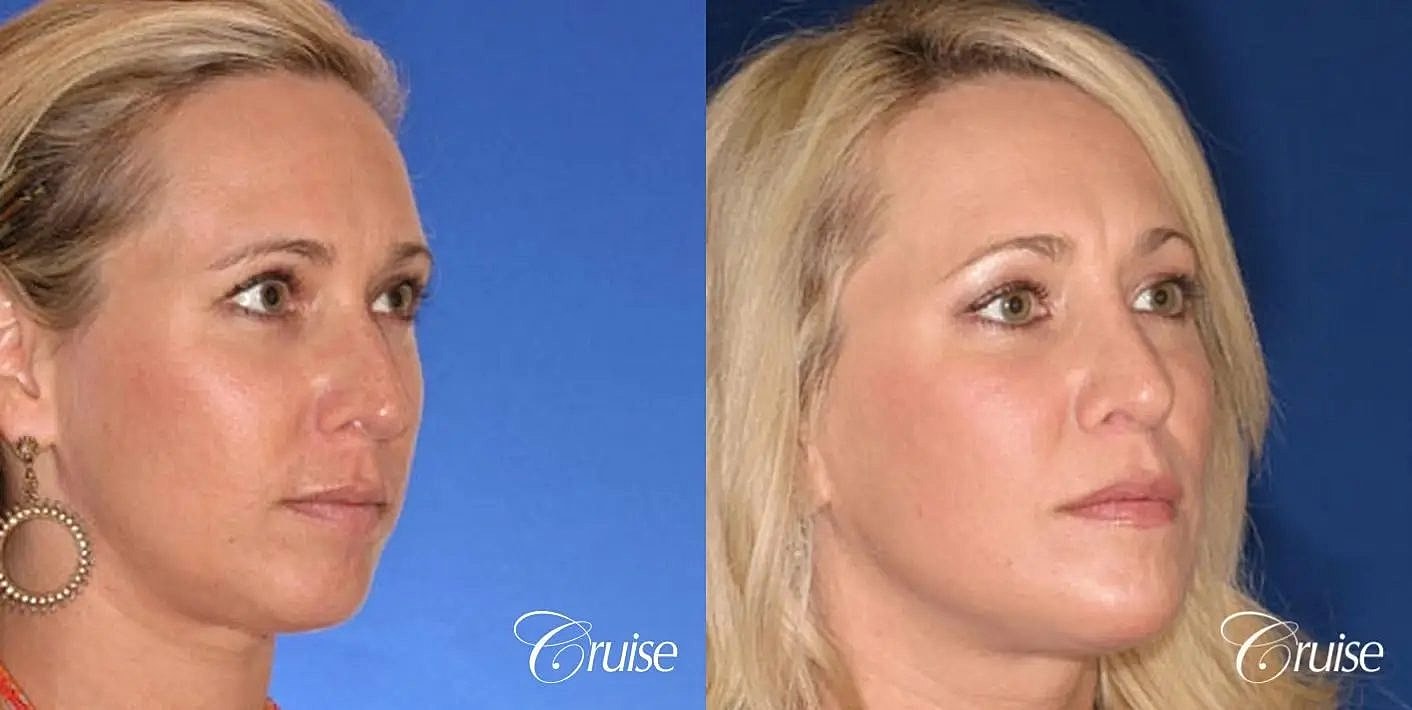 Rhinoplasty Before & After
