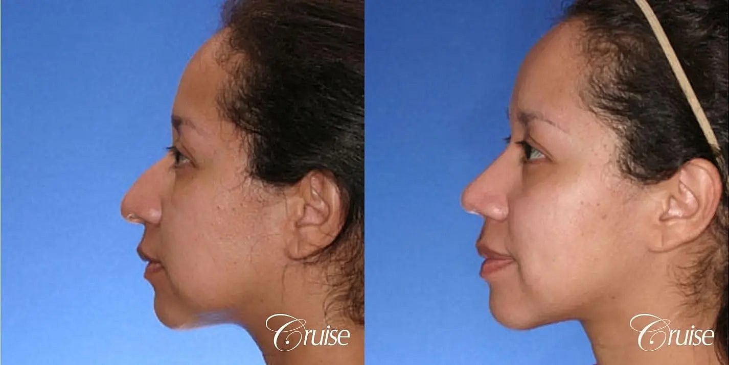 Rhinoplasty Before & After