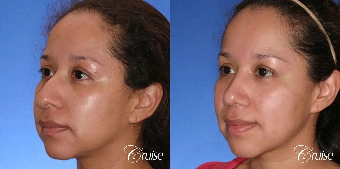 Rhinoplasty Before & After