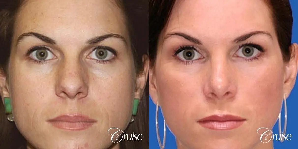 Rhinoplasty Before & After