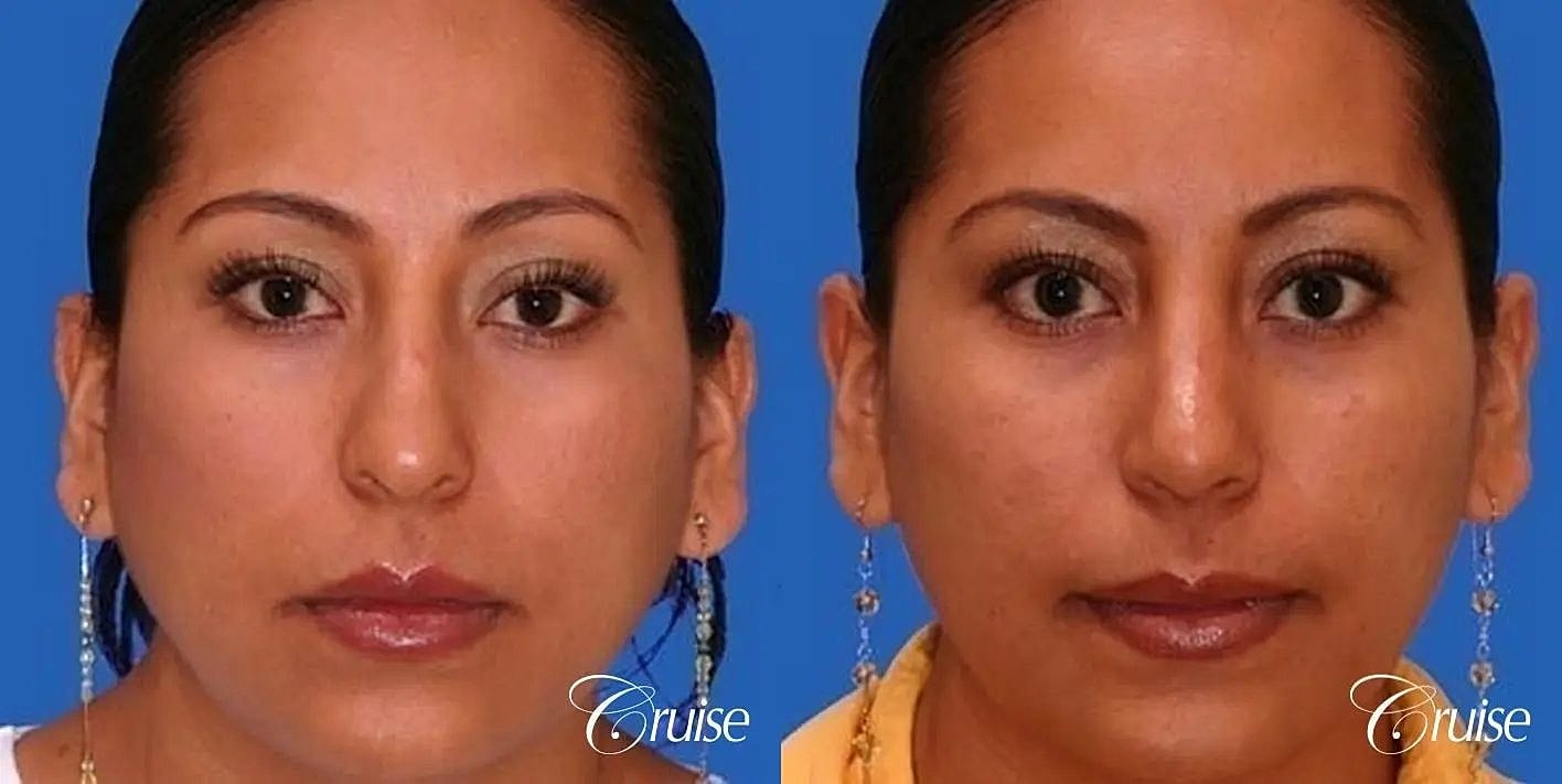 Rhinoplasty Before & After