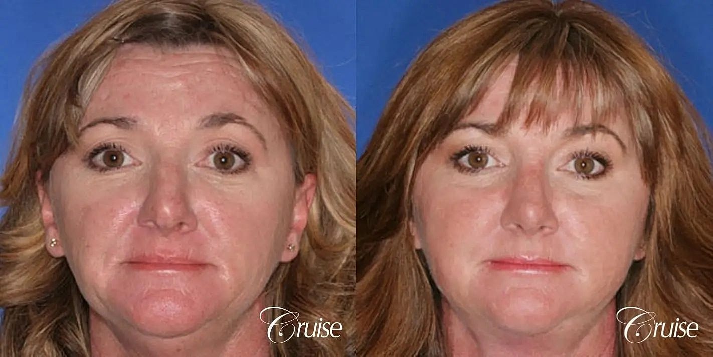 Rhinoplasty Before & After