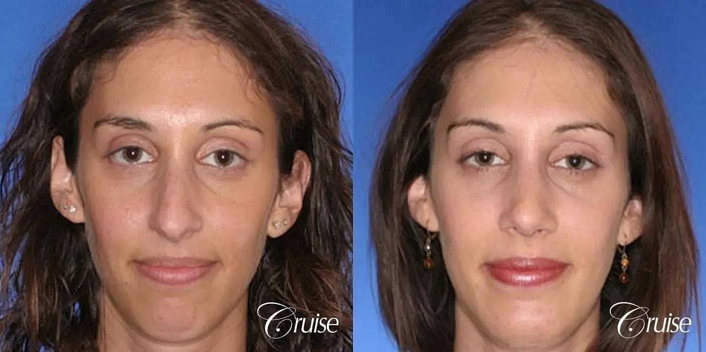 Rhinoplasty Before & After