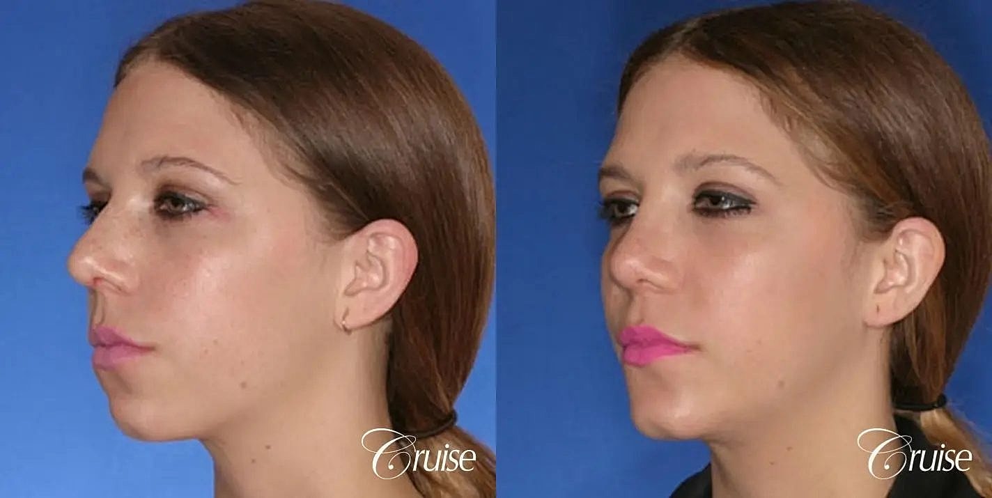 Rhinoplasty Before & After