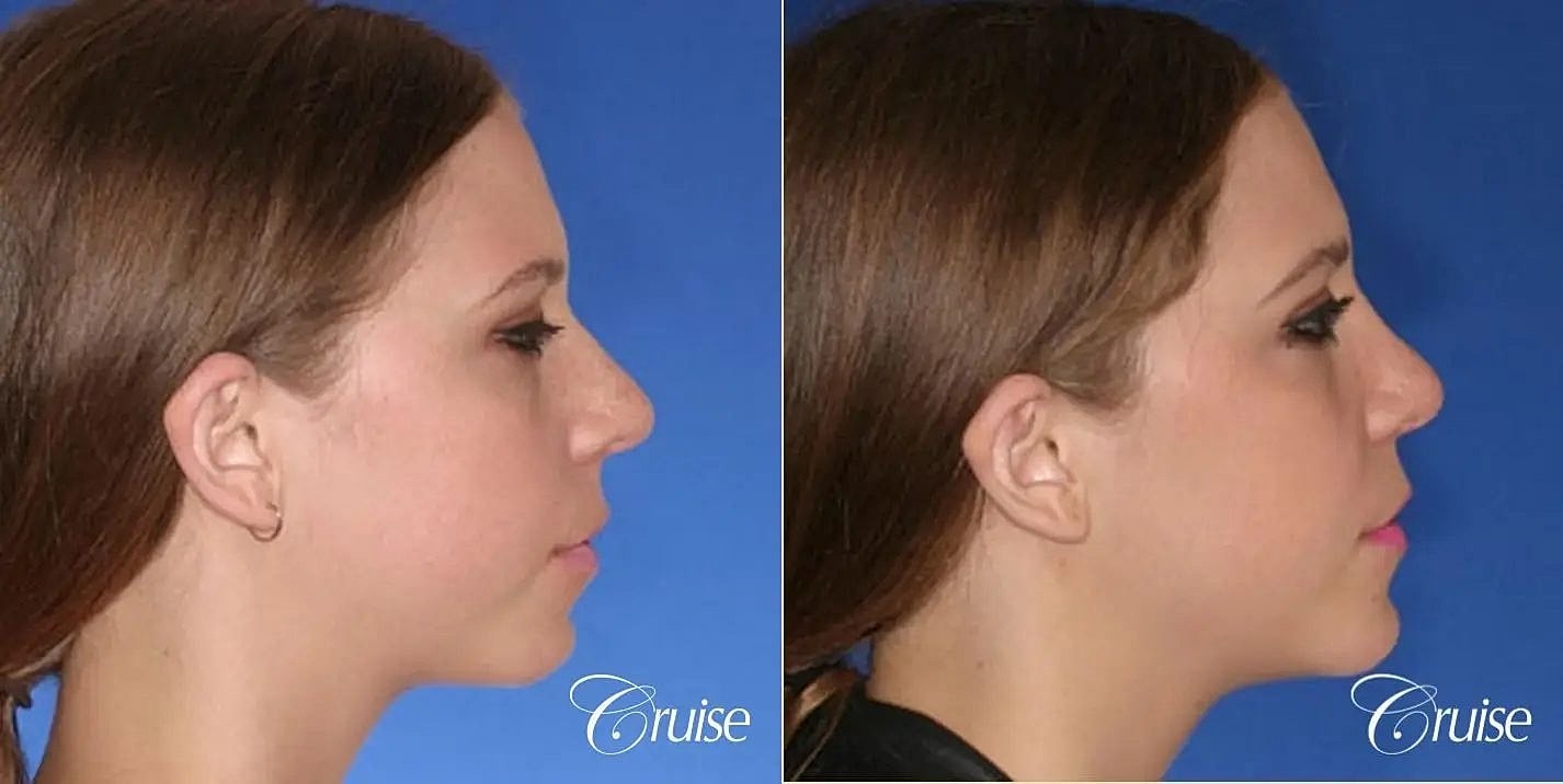 Rhinoplasty Before & After