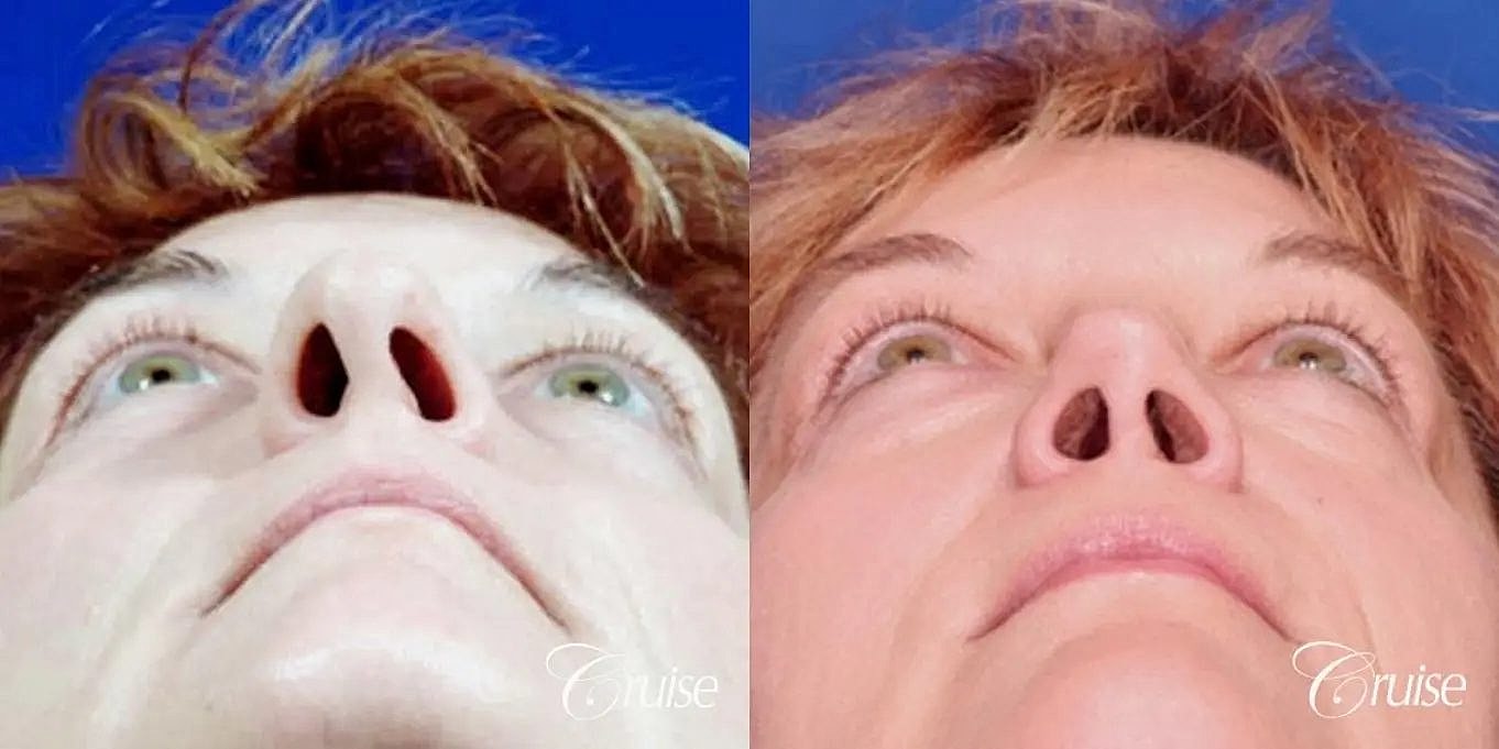 Rhinoplasty Before & After