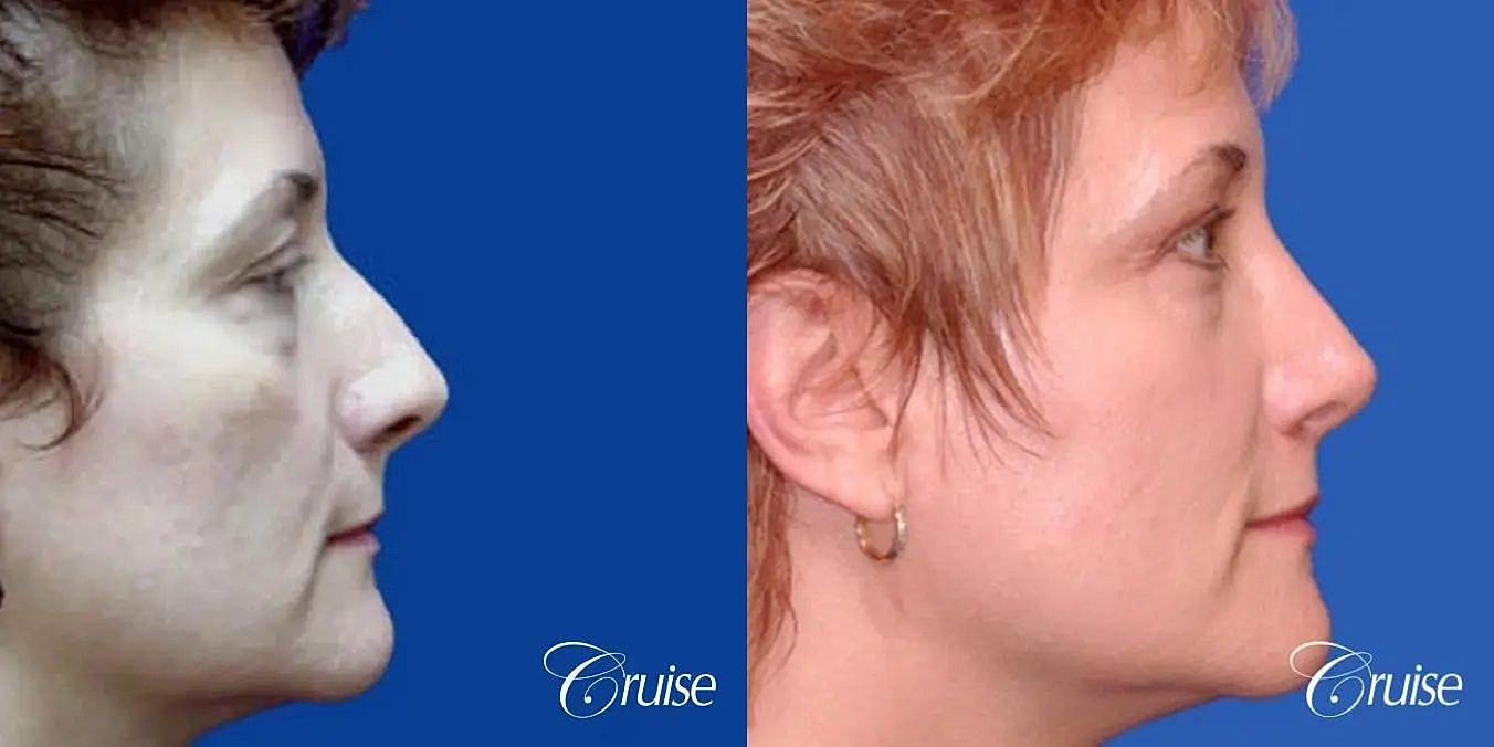 Rhinoplasty Before & After
