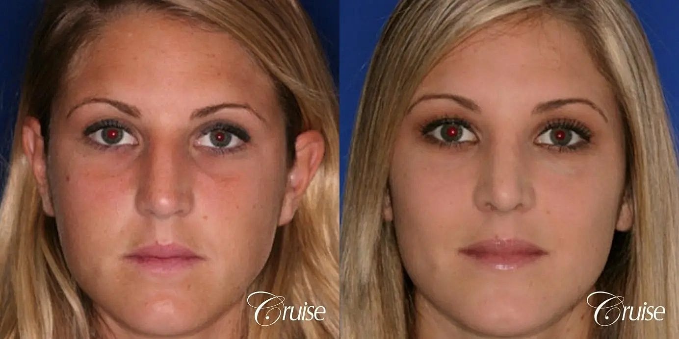 Rhinoplasty Before & After
