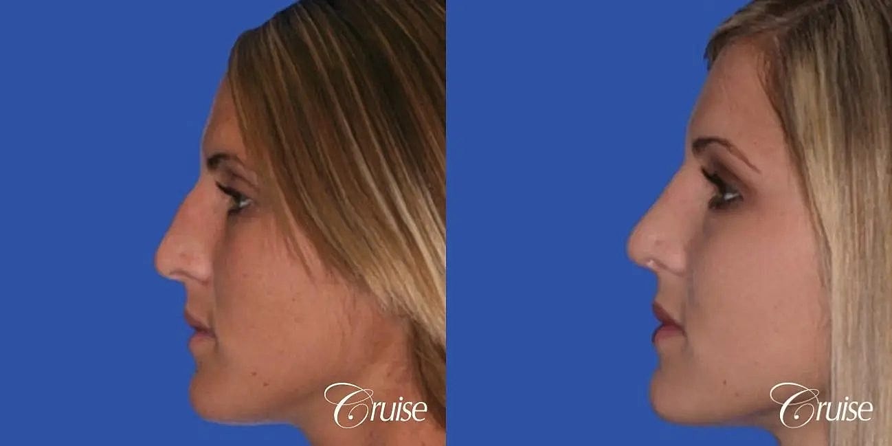 Rhinoplasty Before & After